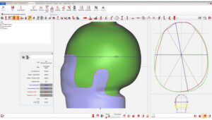 Software 3D utilizado na confecção de órteses