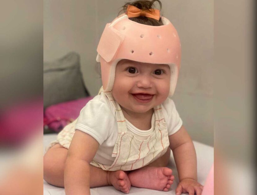 bebê com capacete craniano