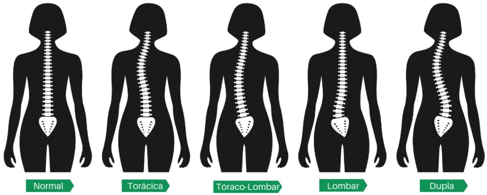 Anatomia da coluna vertebral e a escoliose