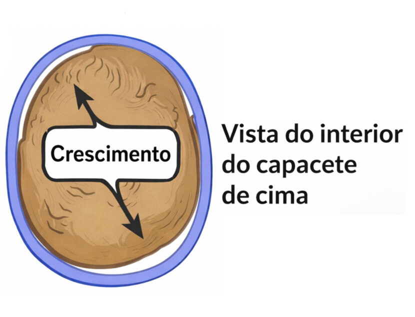 Como funciona a órtese craniana