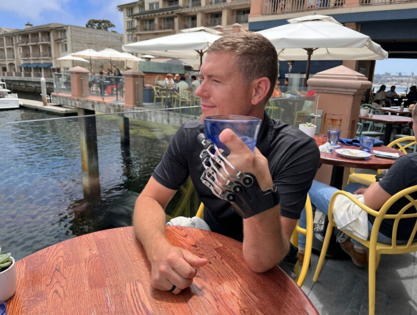 Prótese de dedo: como funciona, quando é indicada e o que realmente muda na função da mão