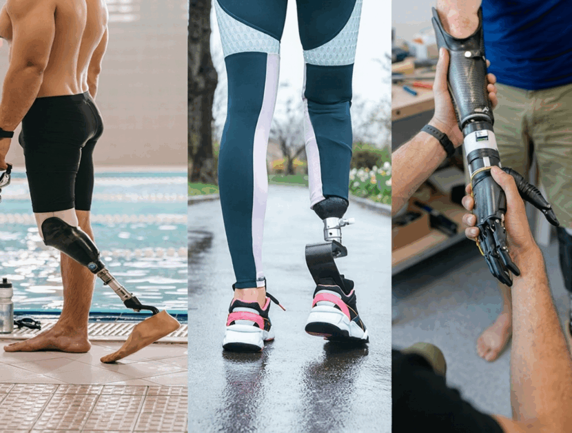 Prótese em Belo Horizonte: guia completo para amputados (onde fazer, tipos, valores e adaptação)